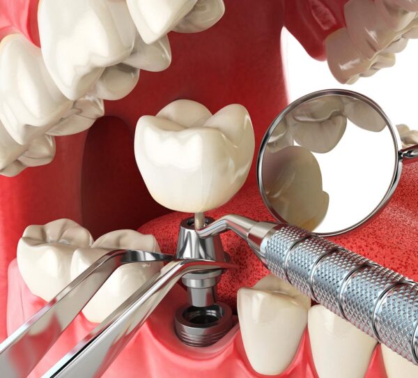 Implantes Dentales Inmediatos Clínica Noguerol 2795