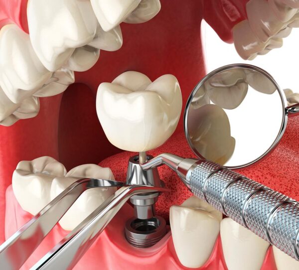 Implantes Dentales Inmediatos Cl Nica Noguerol